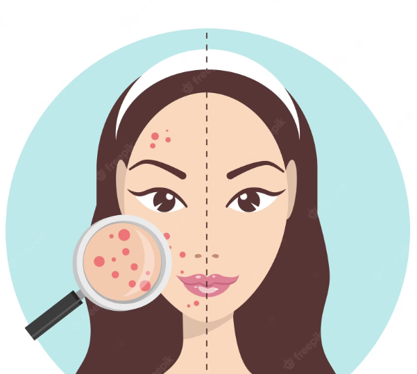 What's the connection between stress and acne?