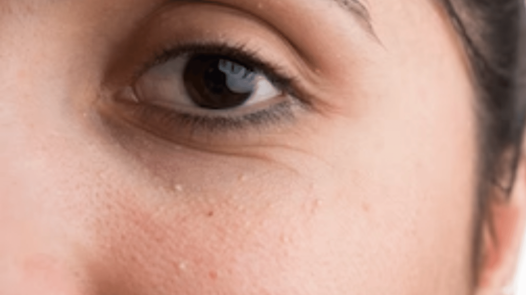 What's Milialar? Eyelid Bumps: Causes, Symptoms, Treatment?